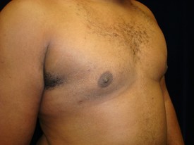 Male Breast Reduction Patient Photo - Case 1116 - after view-1
