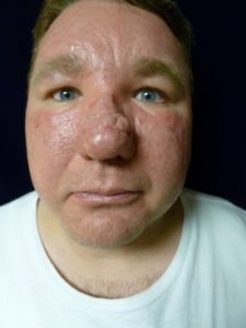 Laser Skin Resurfacing - Case 1131 - Before