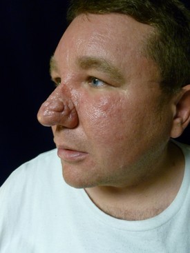 Laser Skin Resurfacing Patient Photo - Case 1131 - before view-1