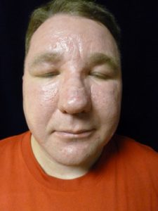 Laser Skin Resurfacing - Case 1131 - After