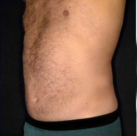 Liposuction Patient Photo - Case 1136 - after view