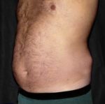 Liposuction - Case 1136 - Before