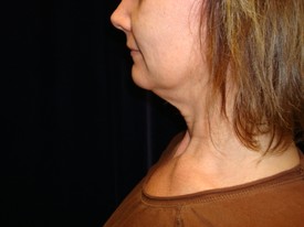 Neck Liposuction Patient Photo - Case 1162 - before view-1