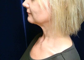 Neck Liposuction Patient Photo - Case 1162 - after view-1