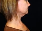 Neck Liposuction - Case 1162 - Before
