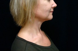 Neck Liposuction Patient Photo - Case 1162 - after view