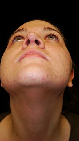 Nose Surgery Patient Photo - Case 1172 - after view-1