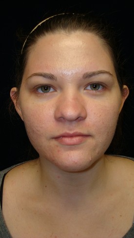 Nose Surgery Patient Photo - Case 1172 - before view-
