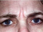 Botox Treatments - Case 994 - Before