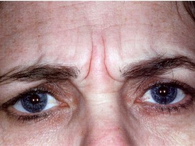Botox Treatments Patient Photo - Case 994 - before view-0