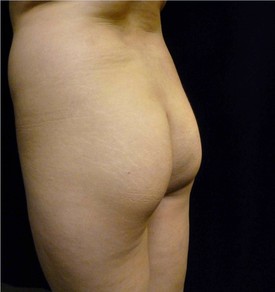 Buttock Lift Patient Photo - Case 1071 - before view-1