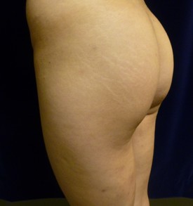 Buttock Lift Patient Photo - Case 1071 - after view-1