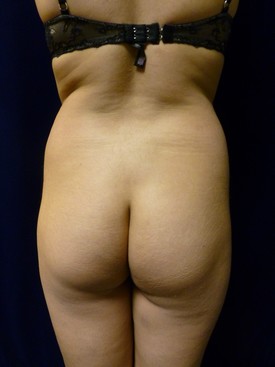 Buttock Lift Patient Photo - Case 1071 - before view-