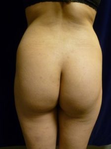 Buttock Lift - Case 1071 - After