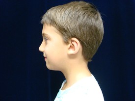 Ear Surgery Patient Photo - Case 1086 - after view-1