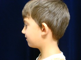 Ear Surgery Patient Photo - Case 1086 - before view-1