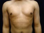 Male Breast Reduction - Case 1121 - Before