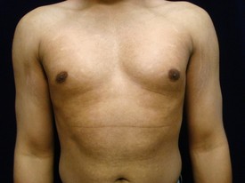 Male Breast Reduction Patient Photo - Case 1121 - before view-
