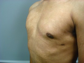 Male Breast Reduction Patient Photo - Case 1121 - after view-1