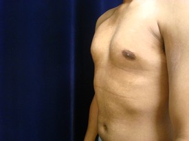 Male Breast Reduction Patient Photo - Case 1121 - before view-1