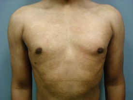Male Breast Reduction Patient Photo - Case 1121 - after view-0