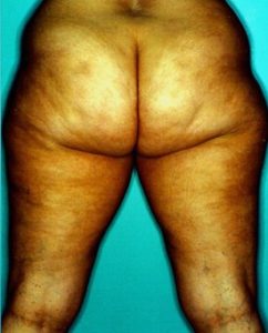 Liposuction - Case 1139 - Before