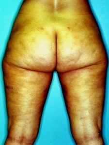 Liposuction - Case 1139 - After