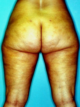 Liposuction Patient Photo - Case 1139 - after view