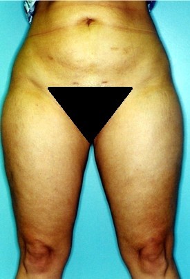 Liposuction Patient Photo - Case 1139 - after view-1