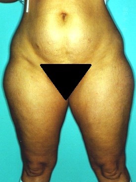 Liposuction Patient Photo - Case 1139 - before view-1