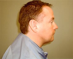 Neck Liposuction Patient Photo - Case 1167 - after view-0