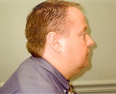 Neck Liposuction Patient Photo - Case 1167 - before view-