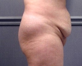 Tummy Tuck Patient Photo - Case 1182 - before view-1