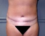Tummy Tuck - Case 1182 - After