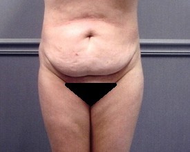 Tummy Tuck Patient Photo - Case 1182 - before view-0