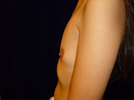Breast Augmentation Patient Photo - Case 1005 - before view-1