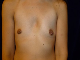 Breast Augmentation - Case 1005 - Before