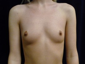 Breast Augmentation Patient Photo - Case 1010 - before view-0
