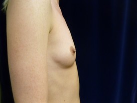Breast Augmentation Patient Photo - Case 1010 - before view-1