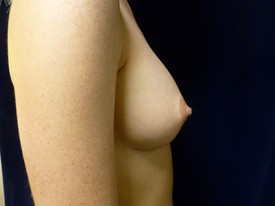 Breast Augmentation Patient Photo - Case 1010 - after view-1