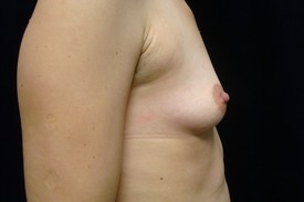 Breast Augmentation Patient Photo - Case 1015 - before view-1