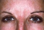 Botox Treatments - Case 997 - After