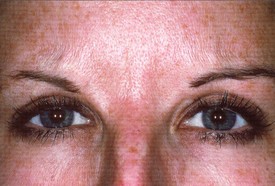 Botox Treatments Patient Photo - Case 997 - after view-0