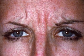 Botox Treatments - Case 997 - Before