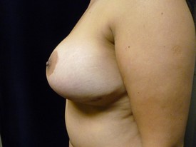 Breast Lift Patient Photo - Case 1035 - after view-1