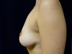 Breast Lift Patient Photo - Case 1035 - before view-1