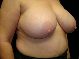 Breast Reduction Patient Photo - Case 1046 - before view-1