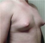 Male Breast Reduction - Case 1126 - Before