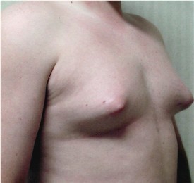 Male Breast Reduction Patient Photo - Case 1126 - before view-0