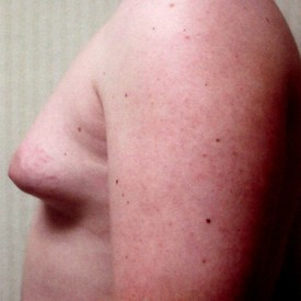 Male Breast Reduction Patient Photo - Case 1126 - before view-1